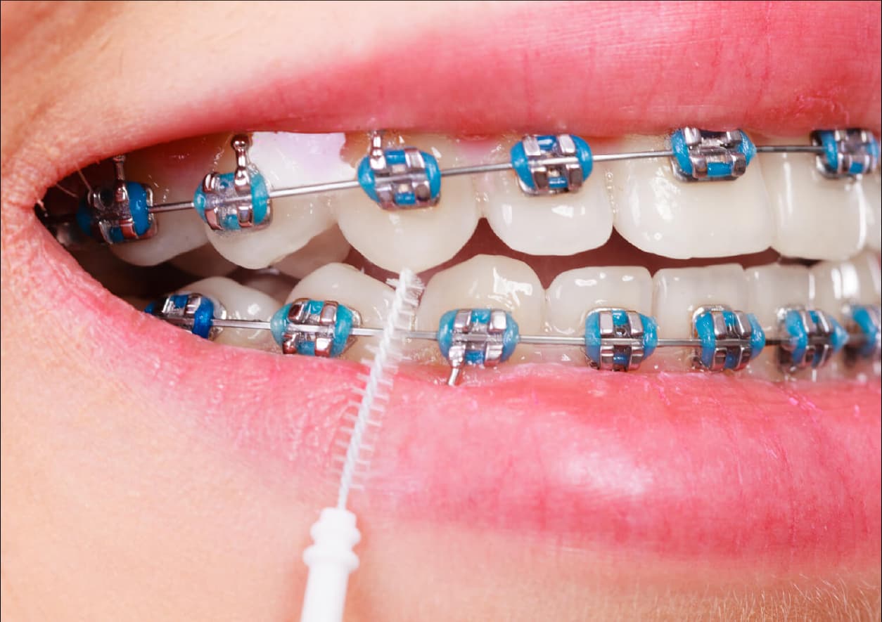Aparelho dentário em Odivelas: sinais de que pode precisar