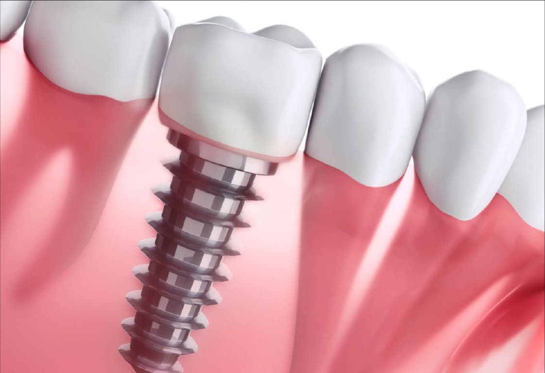 Implante dentário em Odivelas: preço, como funciona e quando é necessário