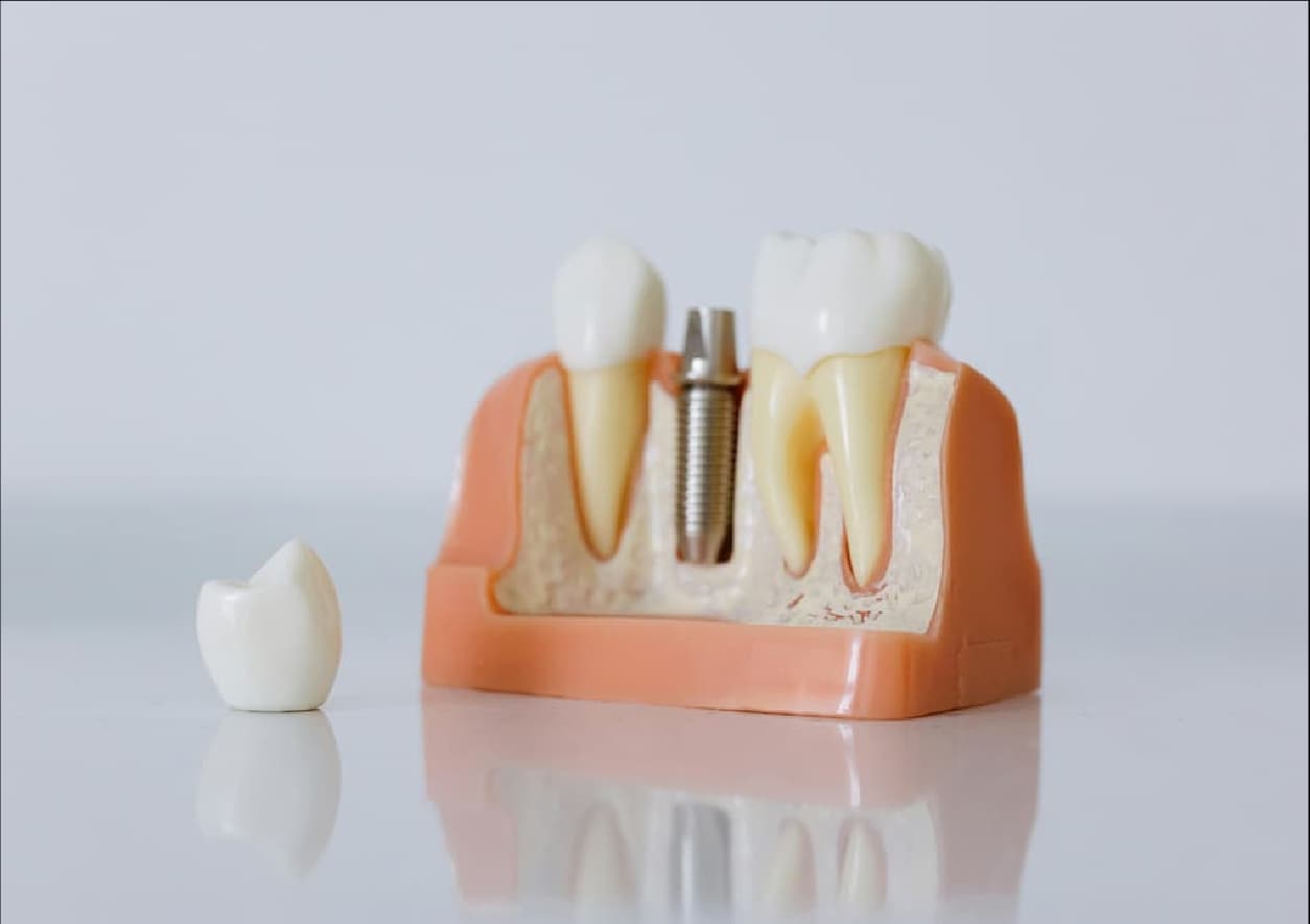 Implantes, Próteses & Restauração